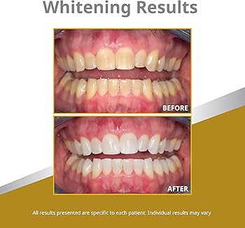 Opalescence 45% PF Teeth Whitening Gel - 4 Pack (4 Syringes, Mint Flavour)