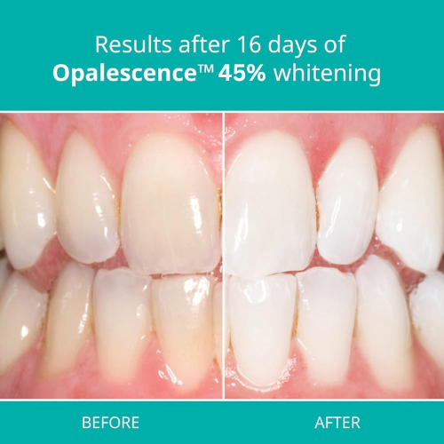Opalescence 45% PF Teeth Whitening Gel - 4 Pack (4 Syringes, Mint Flavour)