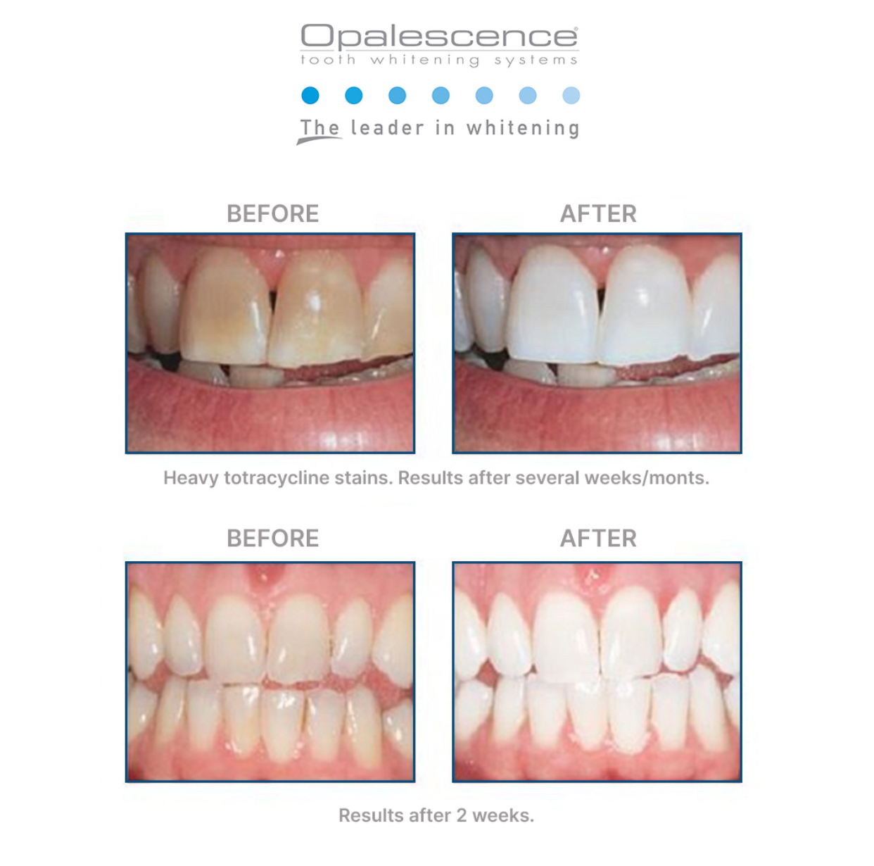 Opalescence™ PF 20% Teeth Whitening Gel - 4 Pack (4 Syringes, Mint Flavour)